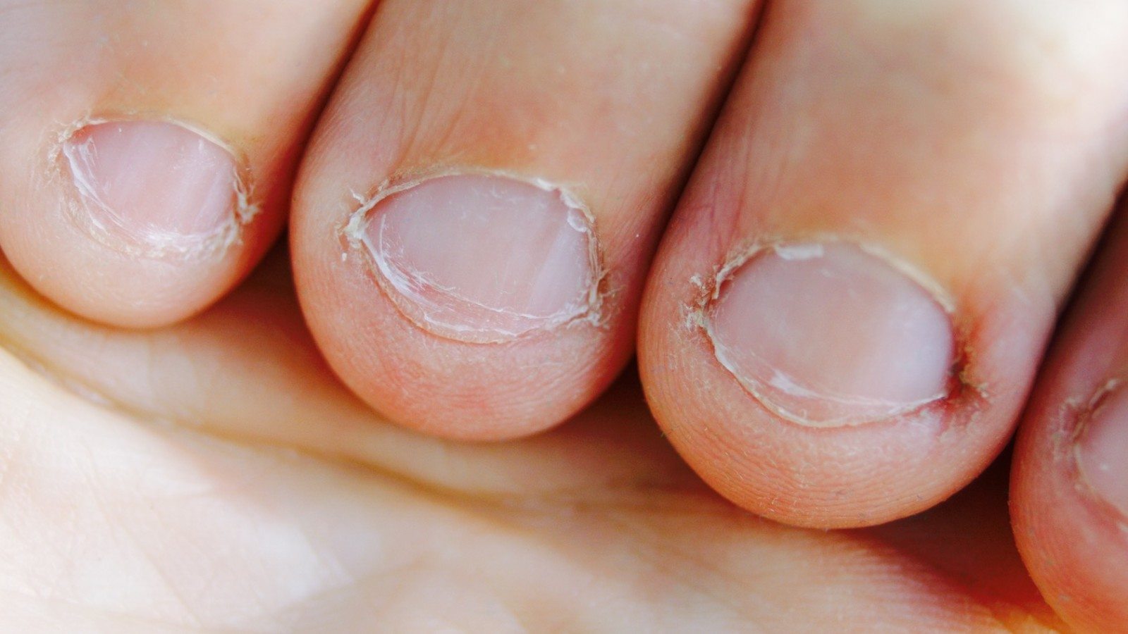 Nail tic disorders: Manifestations, pathogenesis and management - Indian  Journal of Dermatology, Venereology and Leprology