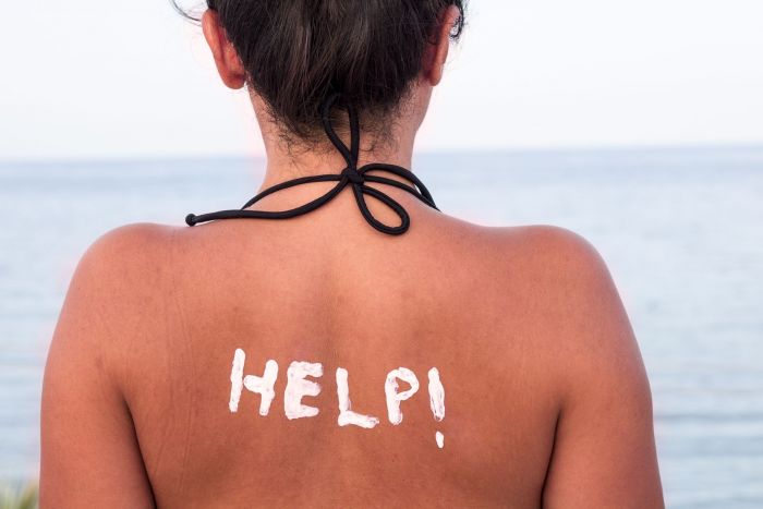 how to get rid of sunburn