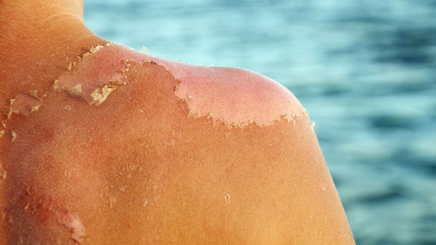 How to Get Rid of Sunburn Fast and Painlessly