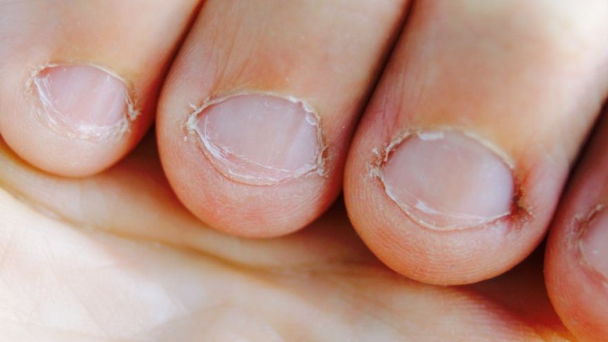 How to Stop Biting Your Nails? Read This!